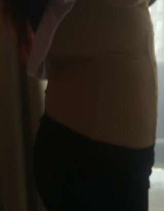 给你们分享丽都医生做的吸脂瘦腰腹