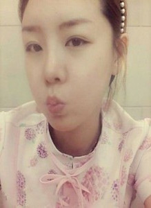 陈万芳医生做的自体脂肪填充面部后变得超年轻