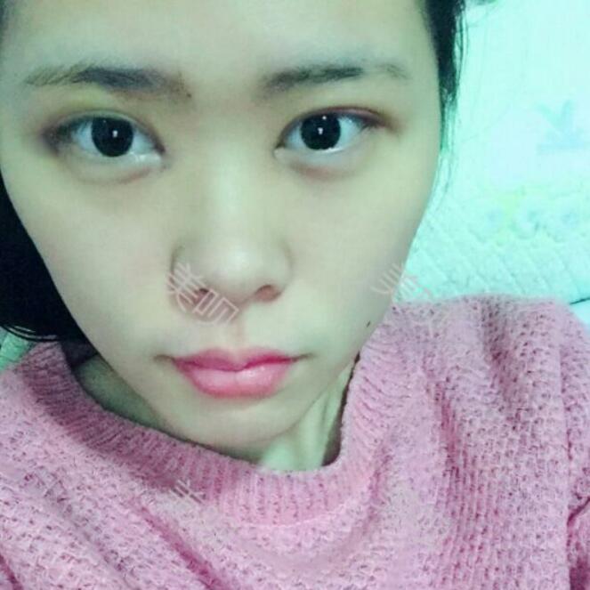 做了切开双眼皮手术后的我爱上了自拍