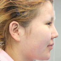 面部吸脂瘦脸后让我从大饼脸变成了巴掌小V脸