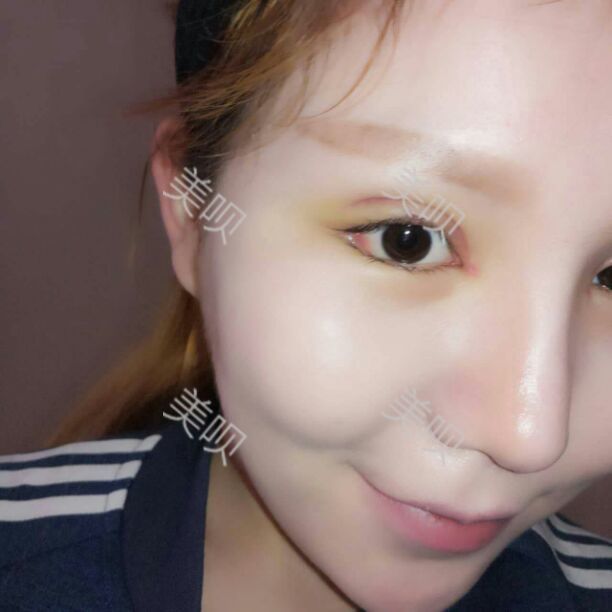 面部吸脂瘦脸后让我从大饼脸变成了巴掌小V脸