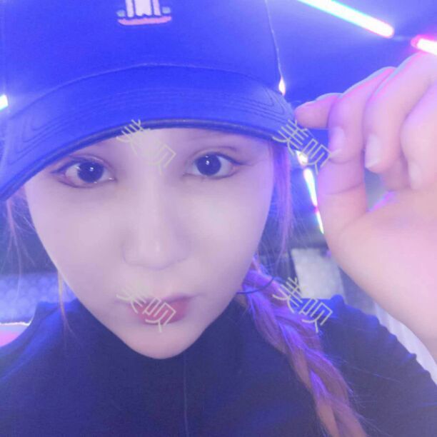 面部吸脂瘦脸后让我从大饼脸变成了巴掌小V脸