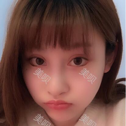 来看看我自体脂肪面部填充后变瓜子脸的锐变过程
