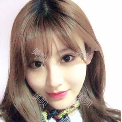 来看看我自体脂肪面部填充后变瓜子脸的锐变过程