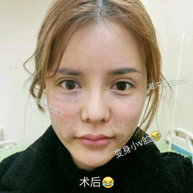 埋蛋白线.提升面部对比图片，颜值哗哗哗的往上涨!!!