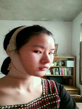 自体脂肪填充下巴前后对比图，进来看看就知道啦!