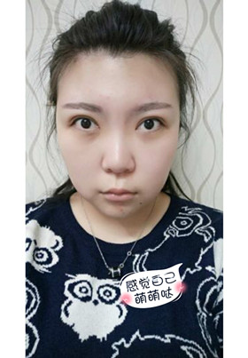激光去眼袋后，整个人都年轻了不少啊!