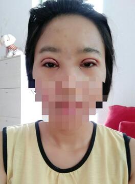 8.15号割的双眼皮 感谢慕医生