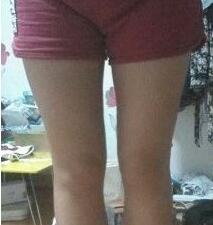 大腿吸脂三个月 瘦了很多