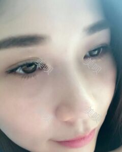 在广州缔妍做了内切去眼袋后年轻多了