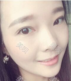 激光去眼袋后终于让我的大眼袋消失了