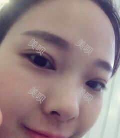 激光去眼袋后终于让我的大眼袋消失了