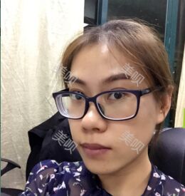 埋埋蛋白线.提升后皮肤紧致了不少也更年轻了