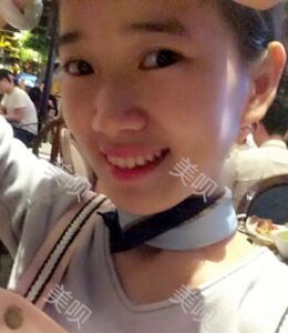 全切双眼皮带给我超自然的美丽双眼