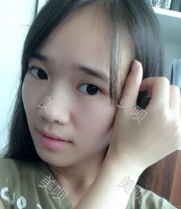 全切双眼皮带给我超自然的美丽双眼