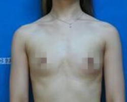 我在北京艺星医疗美容医院自体脂肪隆胸真实经历