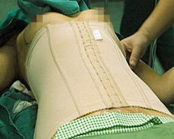 我在北京艺星医疗美容医院自体脂肪隆胸真实经历