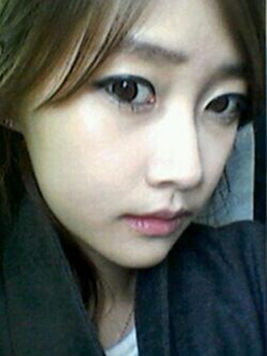 终于做了下颌角磨骨的手术 北京艺星做的 果还不错