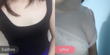 假体隆胸前后对比图
