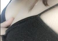 假体隆胸整形经历分享