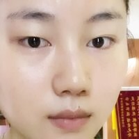 北京全切双眼皮费用2580元，割双眼皮恢复过程分享给大家