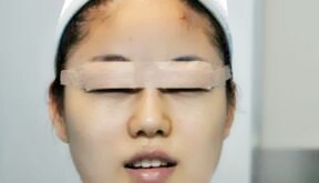 全切双眼皮术后恢复图