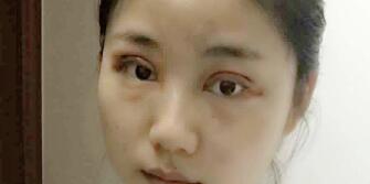 全切双眼皮
