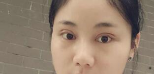 全切双眼皮术后恢复第10天