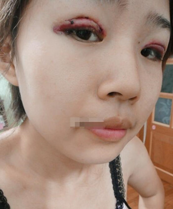 你们来看看艺美门智和做的埋线双眼皮，瞬间变大眼美女