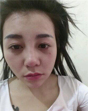 来评价一下华美刘琦做的高强度聚焦超声吧