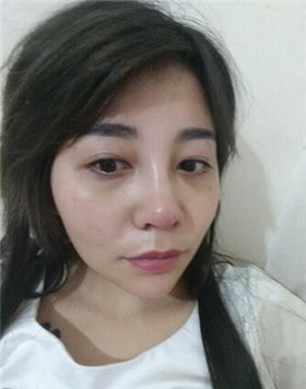 来评价一下华美刘琦做的高强度聚焦超声吧