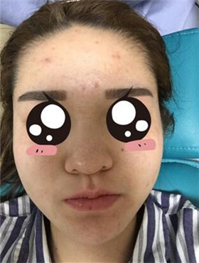 杜姜给我打了水光补水看起来皮肤嫩嫩的