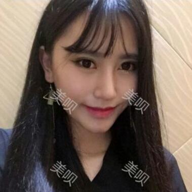自从我玻尿酸隆鼻后吃饭逛街的回头率飙升