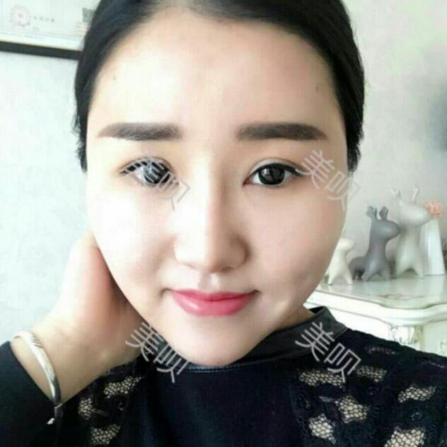 自体脂肪丰太阳穴后整个脸变得好有立体感太美了