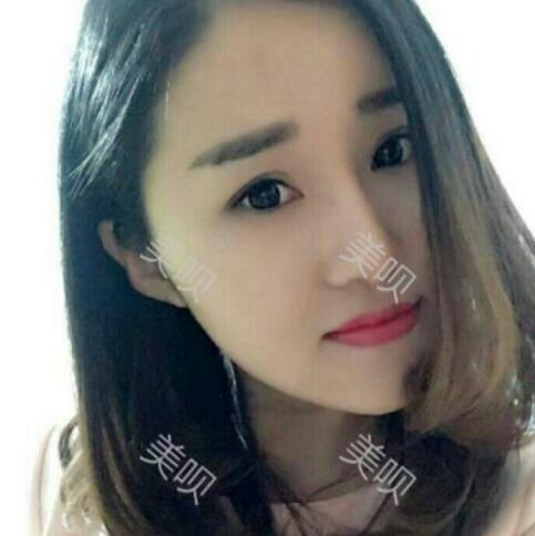 自体脂肪丰太阳穴后整个脸变得好有立体感太美了
