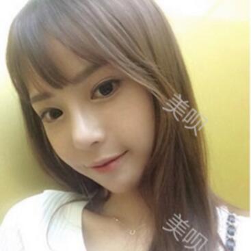 硅胶假体隆鼻后我基本的甩掉了我的驼峰鼻