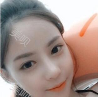 硅胶假体隆鼻后我基本的甩掉了我的驼峰鼻