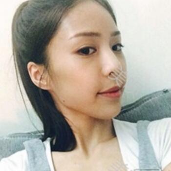 硅胶假体隆鼻后我基本的甩掉了我的驼峰鼻