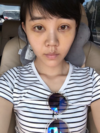 开外眼角手术前后过程对比图片