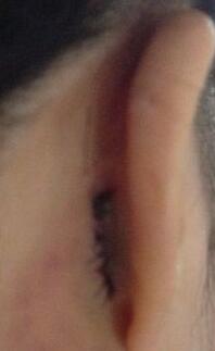 耳软骨隆鼻前后过程图片，见证我变美的过程