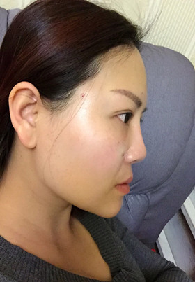 自体脂肪填充面部前后对比图片，真的美了美了!