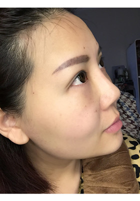 自体脂肪填充面部前后对比图片，真的美了美了!