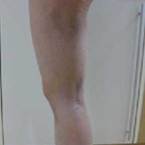 北京禾美嘉大腿吸脂 给大家分享一下体验