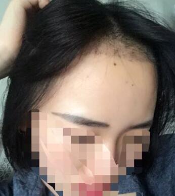成都玉之光头发移植 果杠杠的~