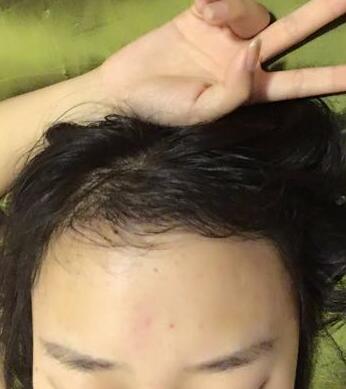 成都玉之光头发移植 果杠杠的~