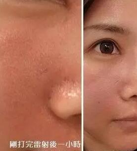 成都玉之光激光嫩肤经历 爱美的MM一定要看