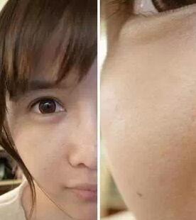 成都玉之光激光嫩肤经历 爱美的MM一定要看