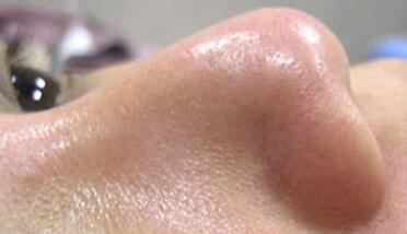 成都玉之光做了杏仁酸换肤 皮肤真的净白无瑕了