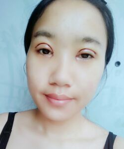 烟台鹏爱魏璐做的全切双眼皮，我也是大眼美女了