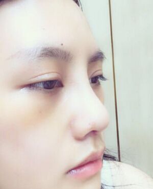 赵煜楠给做的隆鼻整形，看看我鼻子果怎么样